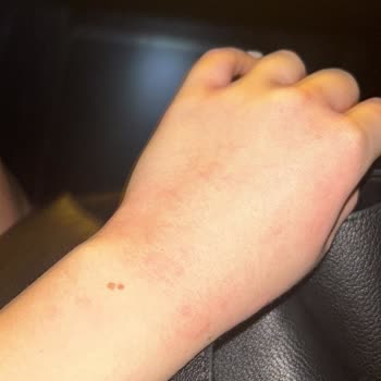 Yanlış İlaç Kullanımı Sonrası Alerjik Reaksiyon