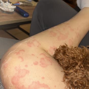 Yanlış İlaç Kullanımı Sonrası Alerjik Reaksiyon