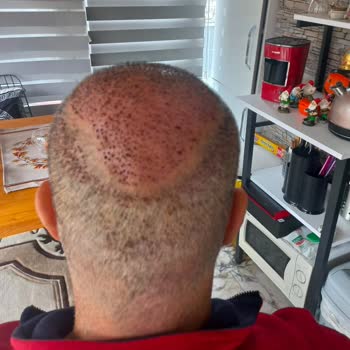 Başarısız Saç Ekimi Ve Ticari Yaklaşım