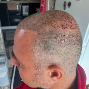 Başarısız Saç Ekimi Ve Ticari Yaklaşım