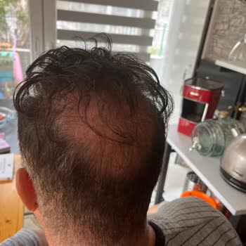 Başarısız Saç Ekimi Ve Ticari Yaklaşım