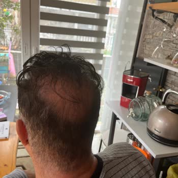 Başarısız Saç Ekimi Ve Ticari Yaklaşım