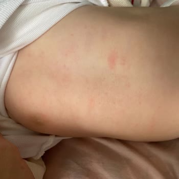 Mustela Bebek Yağı Kullanımı Sonrası Ciltte Döküntü Sorunu