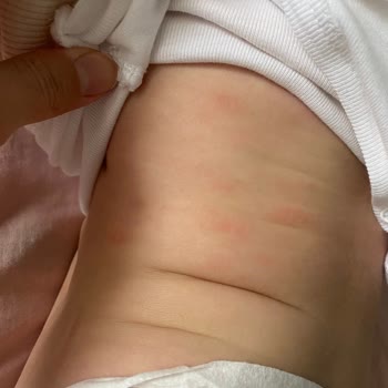 Mustela Bebek Yağı Kullanımı Sonrası Ciltte Döküntü Sorunu