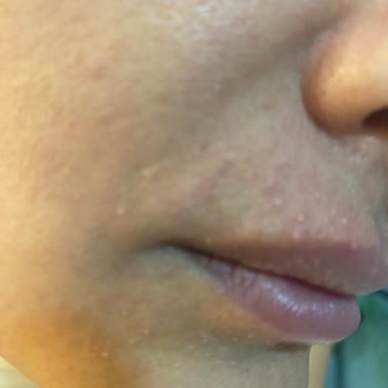 Severe Allergic Reaction to La Roche-Posay Hyalu B5 Serum