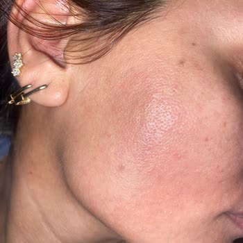 Severe Allergic Reaction to La Roche-Posay Hyalu B5 Serum