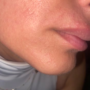 Severe Allergic Reaction to La Roche-Posay Hyalu B5 Serum