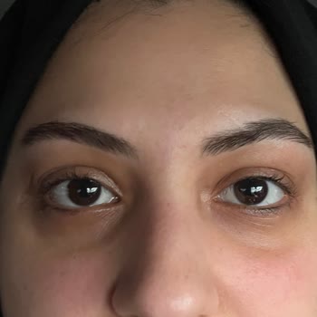 Kirpik Liftingi Deneyiminde Müşteri Memnuniyetsizliği