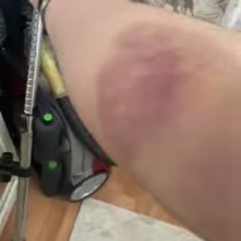 Sağlık Ocağında Kan Alma İşlemi Sonrası Oluşan Morluklar