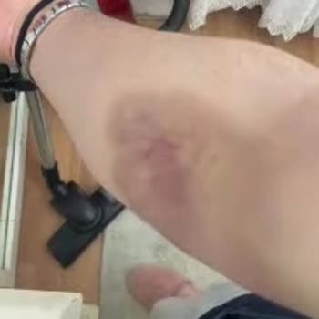 Sağlık Ocağında Kan Alma İşlemi Sonrası Oluşan Morluklar