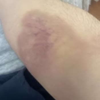 Sağlık Ocağında Kan Alma İşlemi Sonrası Oluşan Morluklar