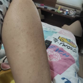 Gillette Venüs Kullanımı Sonrası Cilt Sorunları