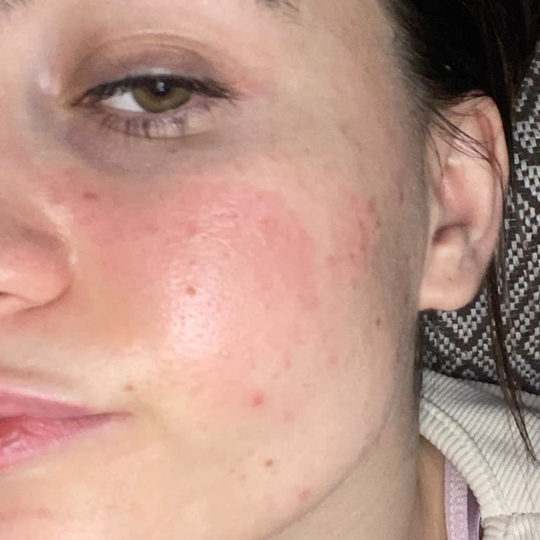 Kömürlü Kil Maskesi Yüzümde Kızarıklık Ve Alerjiye Neden Oldu