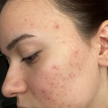 La Roche Ürünlerinin Ciltte Yan Etkileri