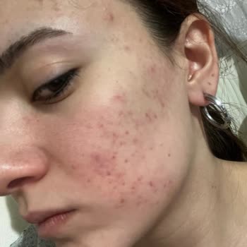 La Roche Ürünlerinin Ciltte Yan Etkileri