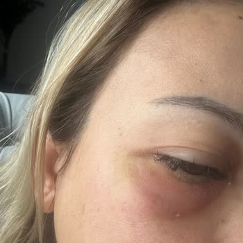 İhsan Türkmen Kliniği Botoks Sorunu