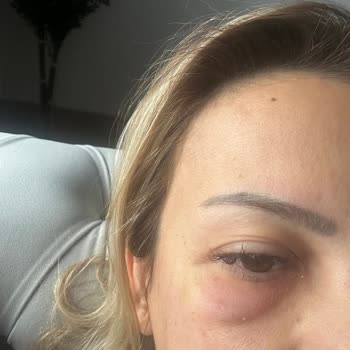 İhsan Türkmen Kliniği Botoks Sorunu