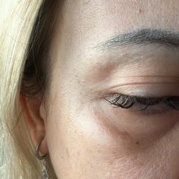 İhsan Türkmen Kliniği Botoks Sorunu