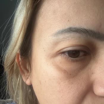 İhsan Türkmen Kliniği Botoks Sorunu