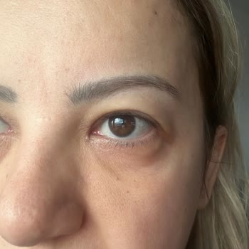 İhsan Türkmen Kliniği Botoks Sorunu