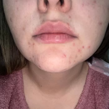 Yves Rocher Sebo Vegetal Worsened My Skin Before My Wedding