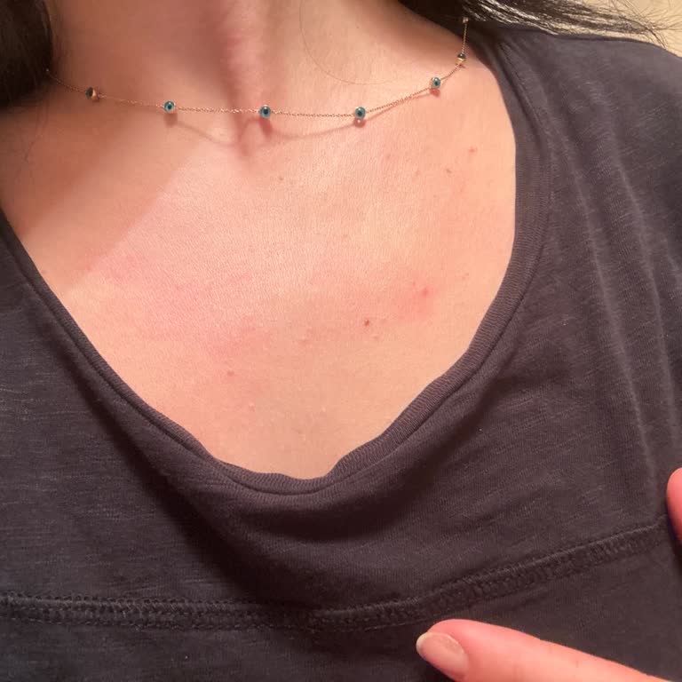 Bingo Toz Deterjan Ciltte Kaşıntı Ve Alerji Yaptı