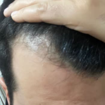 Kök Hücre Tedavisinde Hayal Kırıklığı Ve Etkisizlik