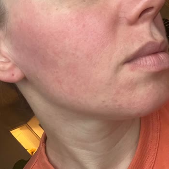 My Skin Turned Very Red From Sebamed Anti-redness Cream