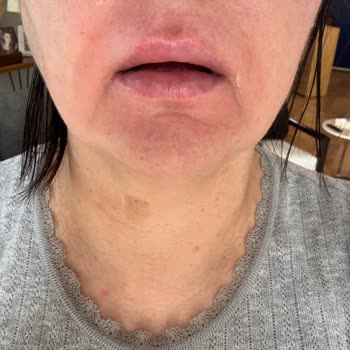 Oral-B Pro 3D White İle Ciltte Yanma Ve Kızarıklık Sorunu