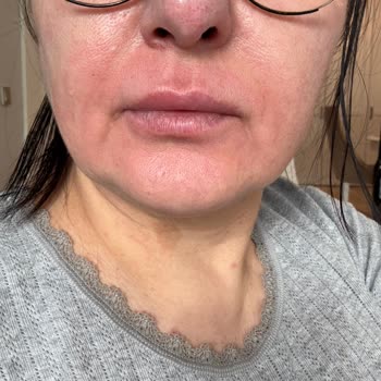 Oral-B Pro 3D White İle Ciltte Yanma Ve Kızarıklık Sorunu