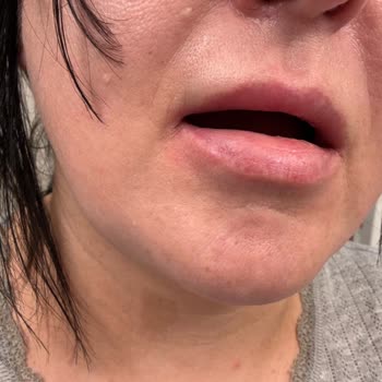 Oral-B Pro 3D White İle Ciltte Yanma Ve Kızarıklık Sorunu