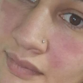 Yves Rocher Ürününden Cilt Sorunları