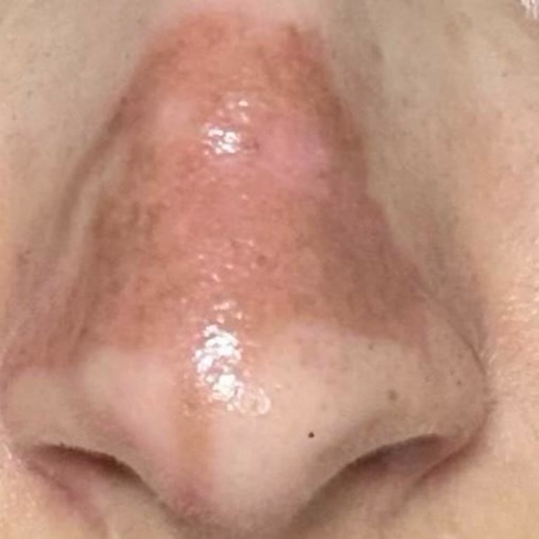 Yanlış Tedavi Sonrası Yüzümde Kalıcı Hasar Riski