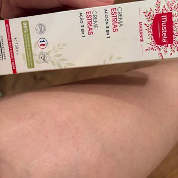 Mustela Çatlak Kremi Yan Etkileriyle Hayal Kırıklığı Yarattı