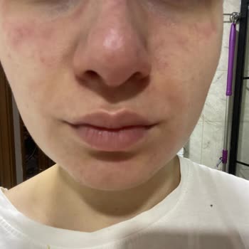 Yves Rocher Pure Menthe Face Wash Sample Caused Skin Irritation