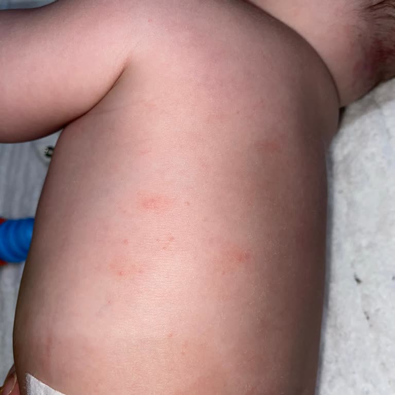 Yanlış İlaç Verilmesi Sonucu Bebeğimde Alerji