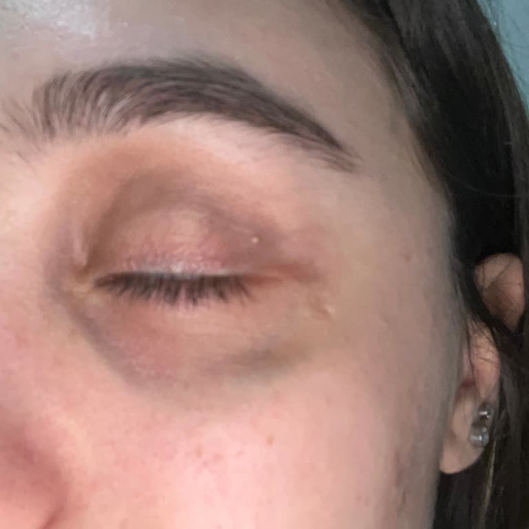 Garnier C Vitaminli Göz Kremi Cilt Sorunlarına Yol Açtı!