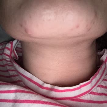 Cilt Bakım Ürünü Hayal Kırıklığı: Sivilceler Ve Boşa Giden Para
