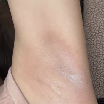 Yves Rocher Roll-On İle Cilt Tahrişi Ve Sağlık Sorunları