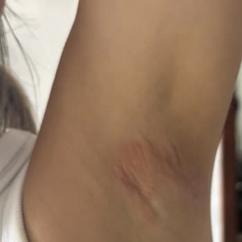 Yves Rocher Roll-On İle Cilt Tahrişi Ve Sağlık Sorunları