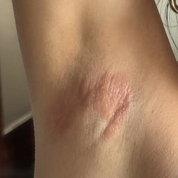 Yves Rocher Roll-On İle Cilt Tahrişi Ve Sağlık Sorunları