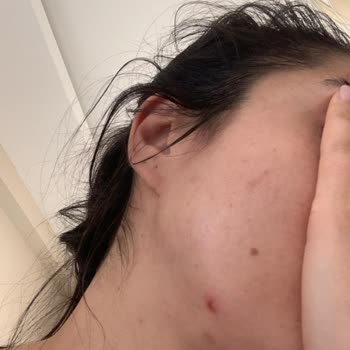 Cilt Ürünleri Kabusu: Sivilce Sorunu