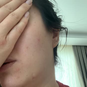 Cilt Ürünleri Kabusu: Sivilce Sorunu