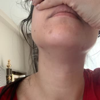 Cilt Ürünleri Kabusu: Sivilce Sorunu