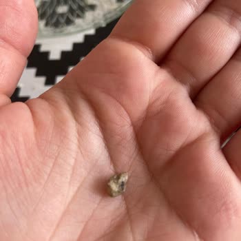 Superfresh Patates İçinden Çıkan Taş Şoku