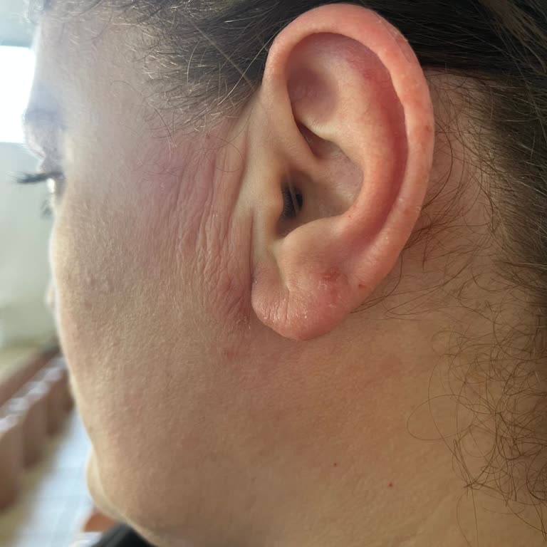 D&R JBL Kulaklık Kullanımı Sonrası Cilt Sorunları