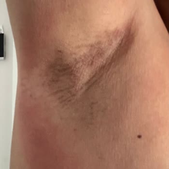 Driclor Kullanımı Sonrası Cilt Yanması Ve Acı