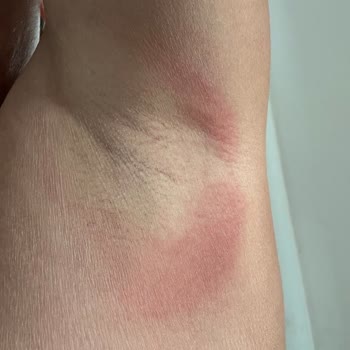 Driclor Kullanımı Sonrası Cilt Yanması Ve Acı