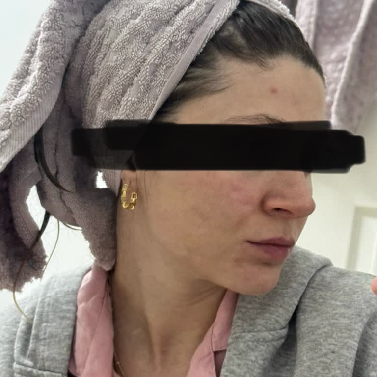 Bitkisel Ürün Alerji Yaptı: Yanlış Bilgilendirme Mağduriyeti