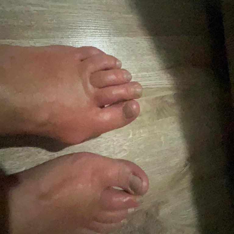 Ayak Maskesi Kabusu: Ciltte Yanık Ve Şişlik